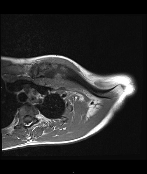 File:Chronic reactive multifocal osteomyelitis (CRMO) - clavicle (Radiopaedia 56406-63071 Axial T1 9).jpg