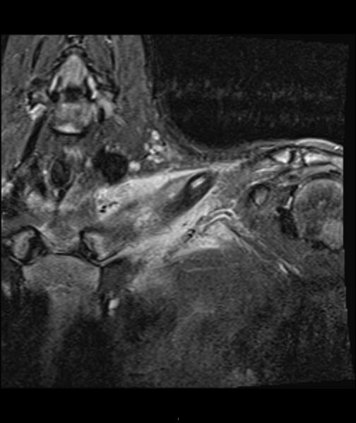 File:Chronic reactive multifocal osteomyelitis (CRMO) - clavicle (Radiopaedia 56406-63071 Coronal STIR 6).jpg