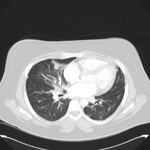 File:Chronic thromboembolic pulmonary hypertension (CTEPH) (Radiopaedia 74597-85531 Axial lung window 29).jpg