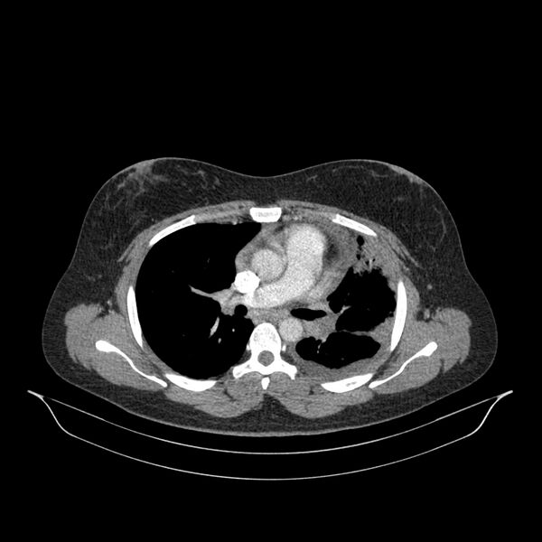 File:Chronic thromboembolic pulmonary hypertension (CTEPH) (Radiopaedia 74597-85532 Axial C+ CTPA 94).jpg