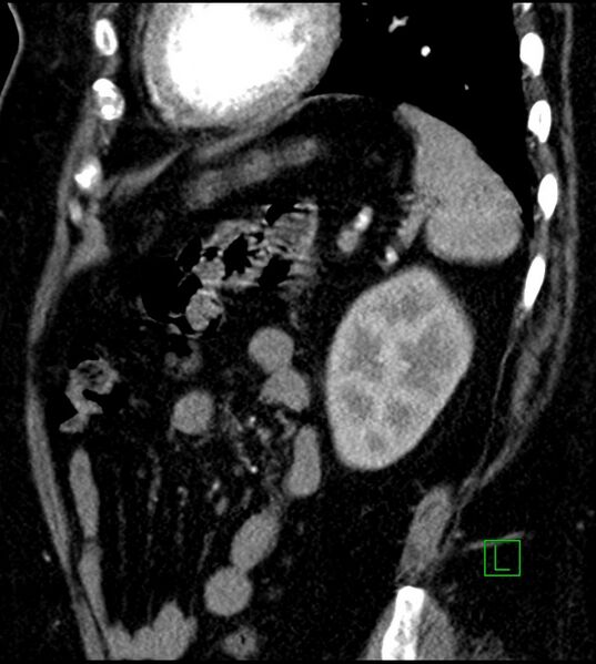 File:Clear cell renal cell carcinoma (Radiopaedia 85004-100537 D 17).jpg