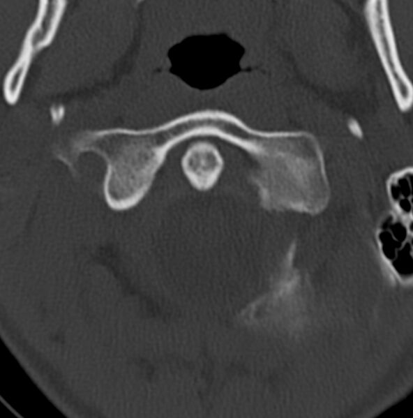 File:Cleft of the posterior arch of C1 mimicking fracture (Radiopaedia 40201-42721 Axial bone window 17).jpg
