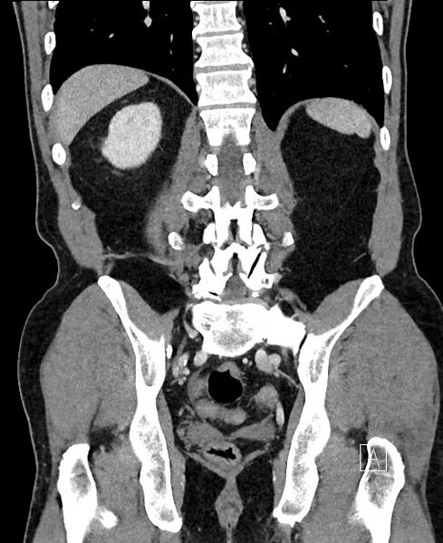 File:Closed loop small bowel obstruction - internal hernia (Radiopaedia 57806-64778 A 87).jpg