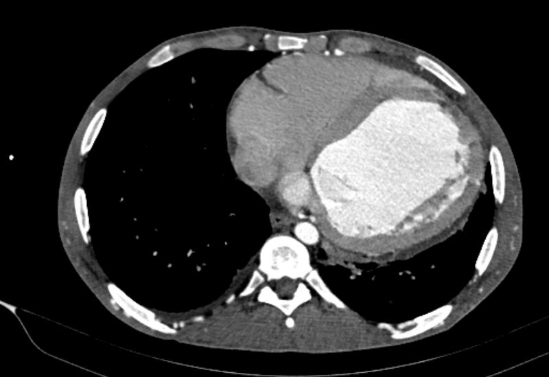 File:Coarctation of aorta with aortic valve stenosis (Radiopaedia 70463-80574 A 158).jpg