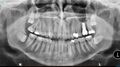 Dentigenous cyst (Radiopaedia 22890).jpg