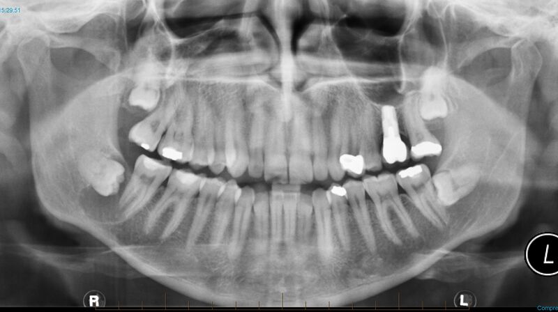 File:Dentigenous cyst (Radiopaedia 22890).jpg