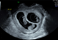 Dichorionic tri-amniotic (DCTA) triplets (Radiopaedia 36543).png