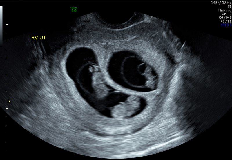 File:Dichorionic tri-amniotic (DCTA) triplets (Radiopaedia 36543).png