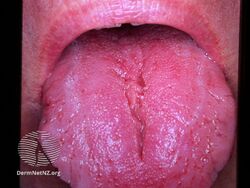 Fissured tongue