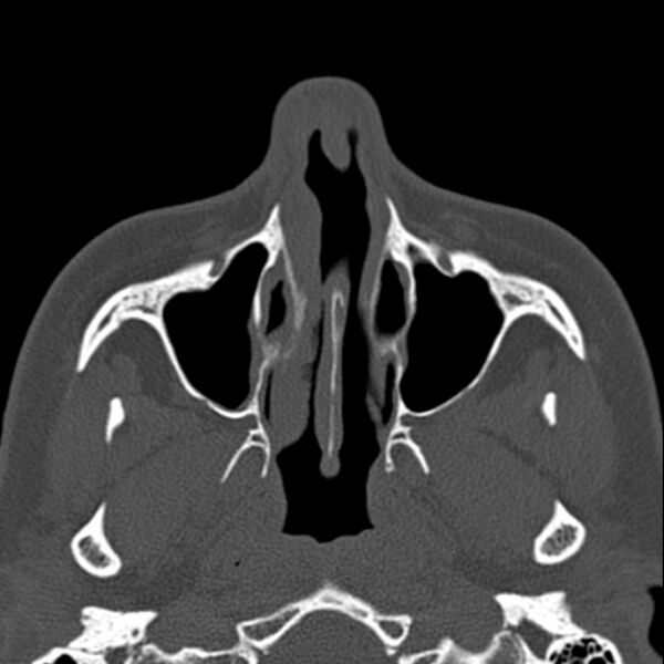 File:Nasal septal perforation (Radiopaedia 25030-25289 Axial bone window 16).jpg