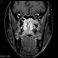 Nasopharyngeal carcinoma (Radiopaedia 4546-6667 E 1).jpg