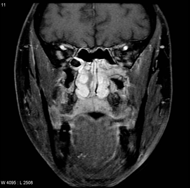 File:Nasopharyngeal carcinoma (Radiopaedia 4546-6667 E 1).jpg