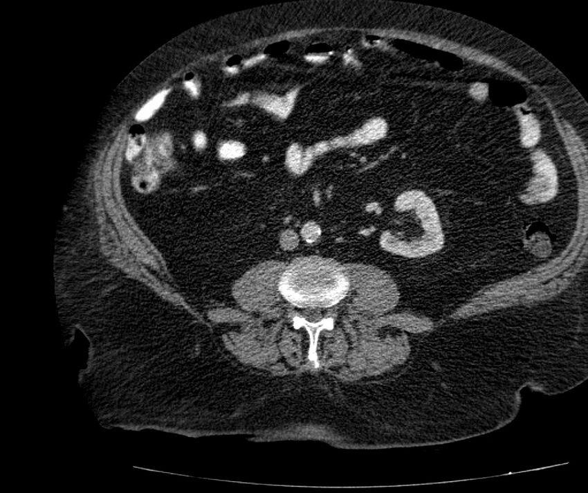 Nephroptosis with inguinal hernia containing perirenal fat (Radiopaedia 56632-63391 C 195).jpg