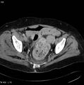 Nerve sheath tumor - malignant - sacrum (Radiopaedia 5219-6987 A 10).jpg