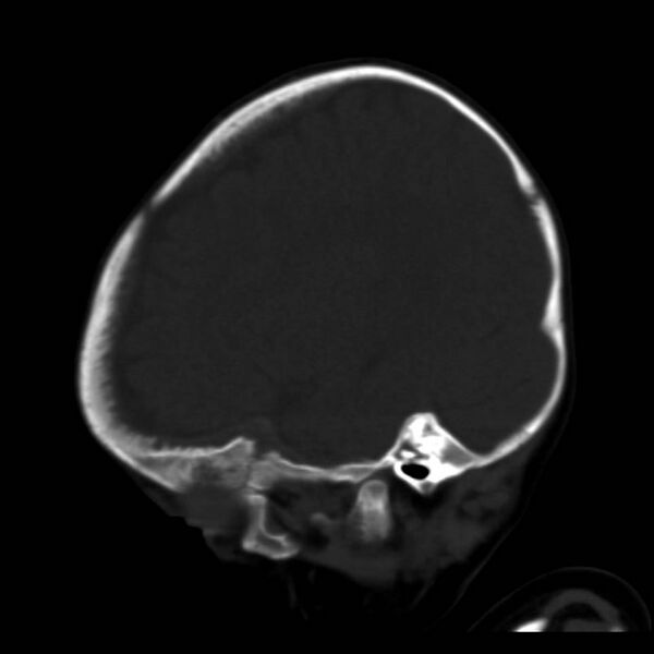 File:Neuroblastoma with skull metastases (Radiopaedia 30326-30958 Sagittal bone window 32).jpg