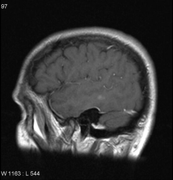 File:Neurosarcoidosis (Radiopaedia 10930-17204 Sagittal T1 C+ 2).jpg