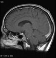 Neurosarcoidosis (Radiopaedia 10930-17204 Sagittal T1 C+ 8).jpg