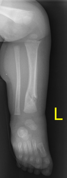 File:Non-accidental injury (Radiopaedia 32878-33854 Frontal 1).png