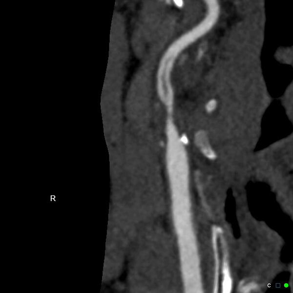 File:Non-occlusive intraluminal internal carotid artery thrombus (Radiopaedia 37751-39658 A 5).jpg
