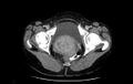 Non-puerperal uterine inversion (Radiopaedia 78343-91094 A 68).jpg