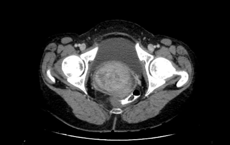 File:Non-puerperal uterine inversion (Radiopaedia 78343-91094 A 68).jpg