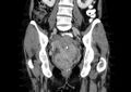 Non-puerperal uterine inversion (Radiopaedia 78343-91094 B 25).jpg