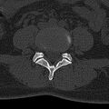 Normal CT lumbar spine (Radiopaedia 53981-60118 Axial bone window 52).jpg