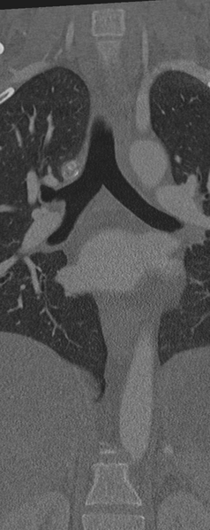 File:Normal CT thoracic spine (Radiopaedia 40181-42688 Coronal bone window 18).png