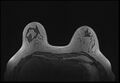 Normal breast MRI - dense breasts (Radiopaedia 80454-93850 Axial T1 59).jpg