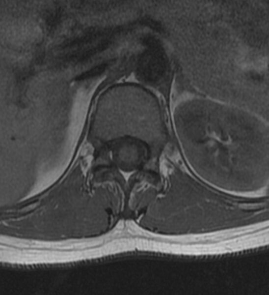 File:Normal thoracic spine MRI (Radiopaedia 41033-43781 Axial T1 27).jpg