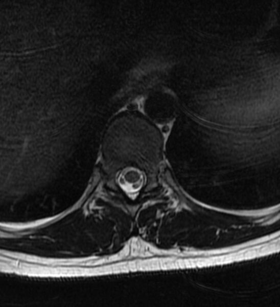 File:Normal thoracic spine MRI (Radiopaedia 41033-43781 Axial T2 14).jpg