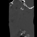Normal trauma cervical spine (Radiopaedia 41017-43760 Sagittal bone window 2).png