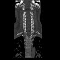 Occipital condyle fracture (Radiopaedia 31755-32691 Coronal bone window 17).jpg