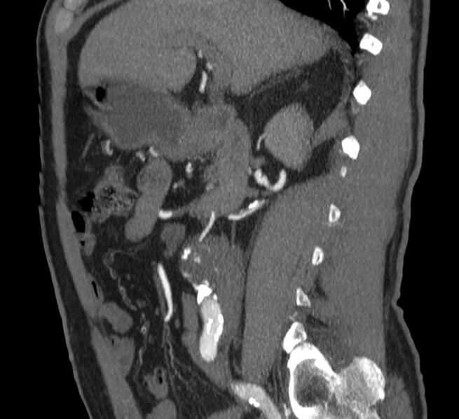 File:Abdominal aortic aneurysm (Radiopaedia 22421-22458 D 12).jpg