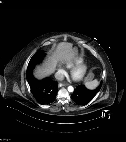 File:Abdominal aortic aneurysm with intramural hematoma then rupture (Radiopaedia 50278-55632 Axial C+ arterial phase 24).jpg