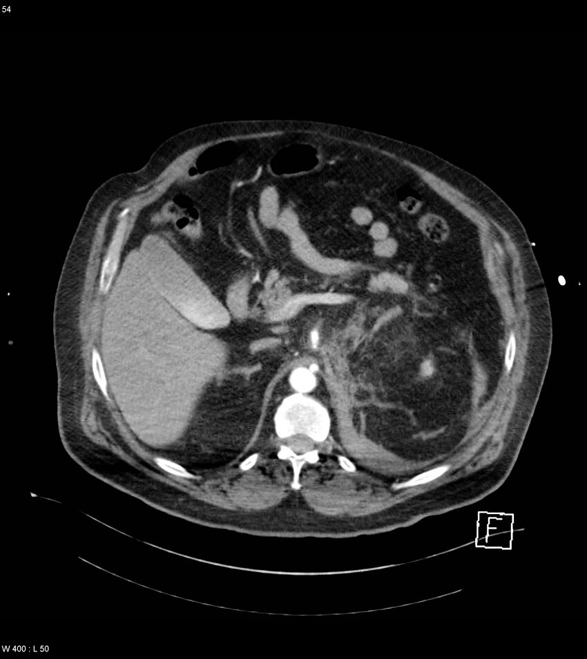 Abdominal aortic aneurysm with intramural hematoma then rupture (Radiopaedia 50278-55632 Axial C+ arterial phase 53).jpg