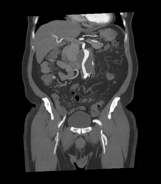 File:Abdominal aortic aneurysm with thrombus fissuration (Radiopaedia 46218-50618 Coronal C+ arterial phase 23).jpg