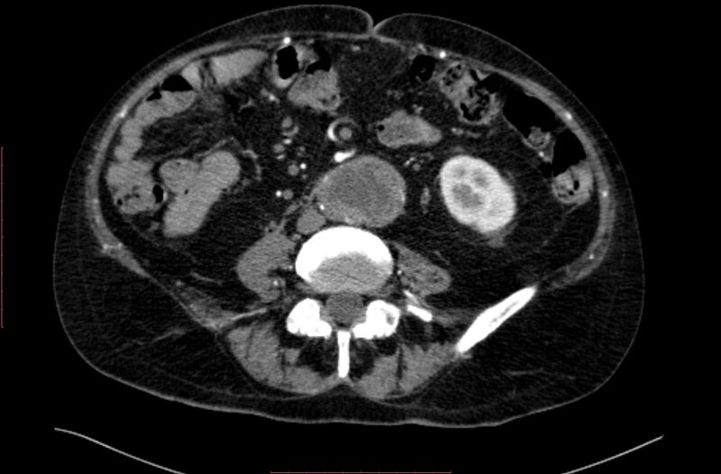 File:Abdominal aortic interposition tube graft and aneurysm thrombosis (Radiopaedia 71438-81857 Axial C+ arterial phase 110).jpg