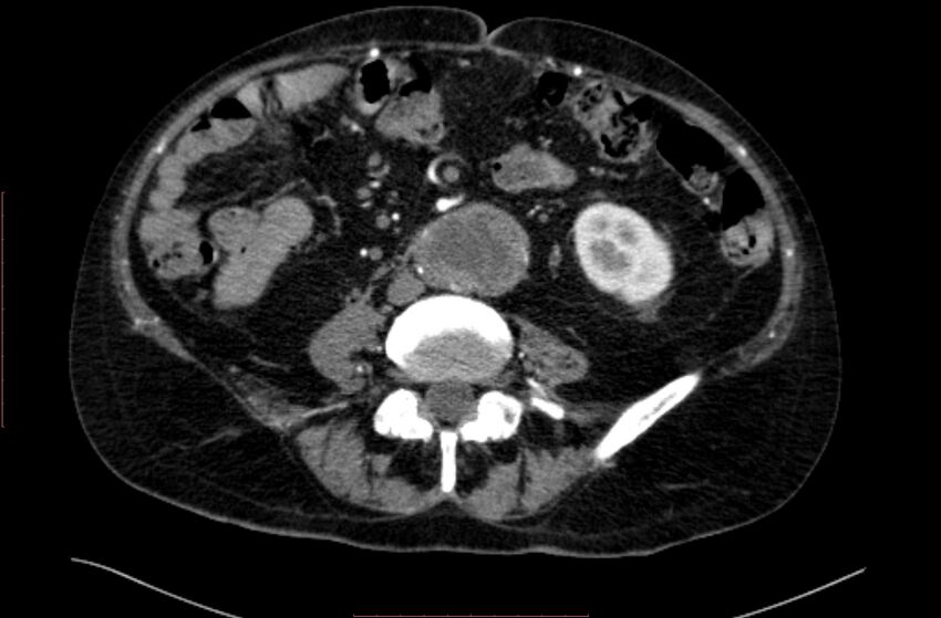 Abdominal aortic interposition tube graft and aneurysm thrombosis (Radiopaedia 71438-81857 Axial C+ arterial phase 110).jpg