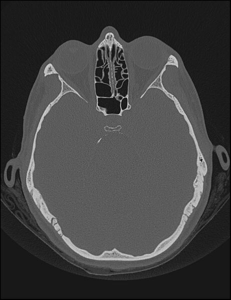 File:Aberrant right internal carotid artery (Radiopaedia 65191-74198 Axial non-contrast 66).jpg