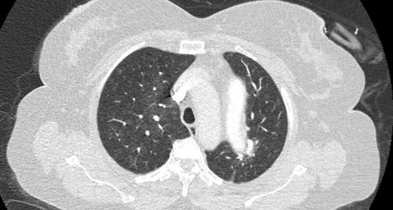File:Accessory right inferior hepatic vein (Radiopaedia 65245-74259 Axial lung window 15).jpg