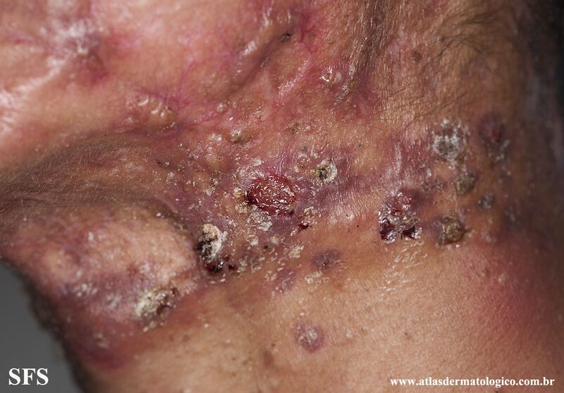File:Acne Fulminans (Dermatology Atlas 16).jpg
