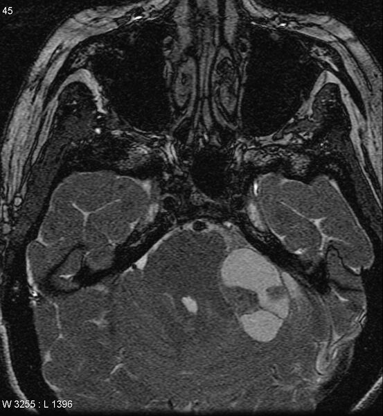 File:Acoustic schwannoma (large with cystic change) (Radiopaedia 5369-7130 Axial T2 7).jpg