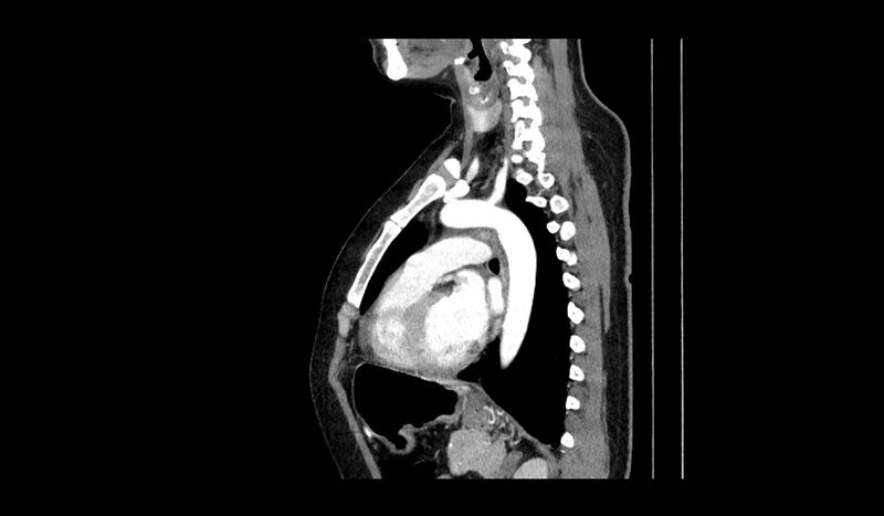 File:Acquired tracheo-esophageal fistula (Radiopaedia 51356-57103 Sagittal C+ arterial phase 5).jpg