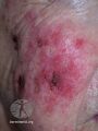 Actinic Keratoses treated with imiquimod (DermNet NZ lesions-ak-imiquimod-3769).jpg