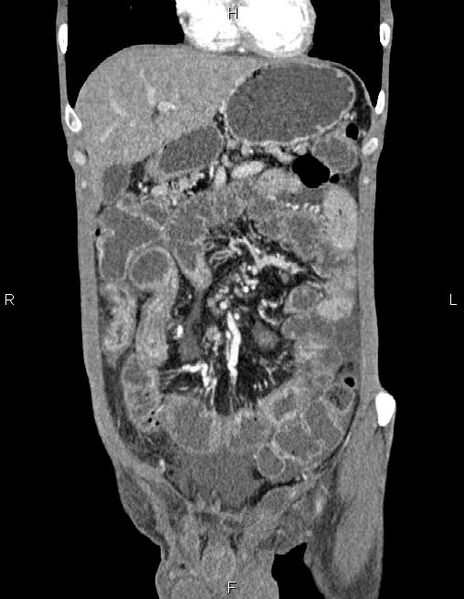 File:Active crohn disease (Radiopaedia 87133-103397 Coronal C+ arterial phase 16).jpg