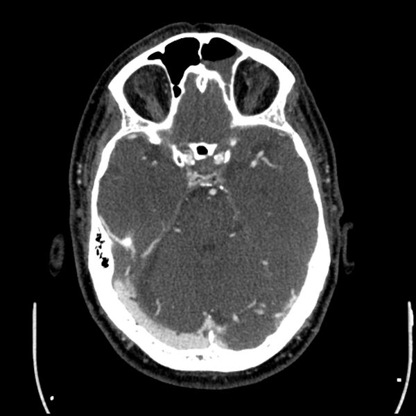 File:Acute A3 occlusion with ACA ischemic penumbra (CT perfusion) (Radiopaedia 72036-82527 Axial C+ arterial phase thins 117).jpg