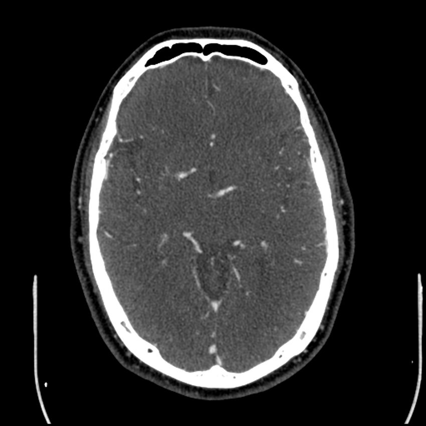 Acute A3 occlusion with ACA ischemic penumbra (CT perfusion) (Radiopaedia 72036-82527 Axial C+ arterial phase thins 82).jpg