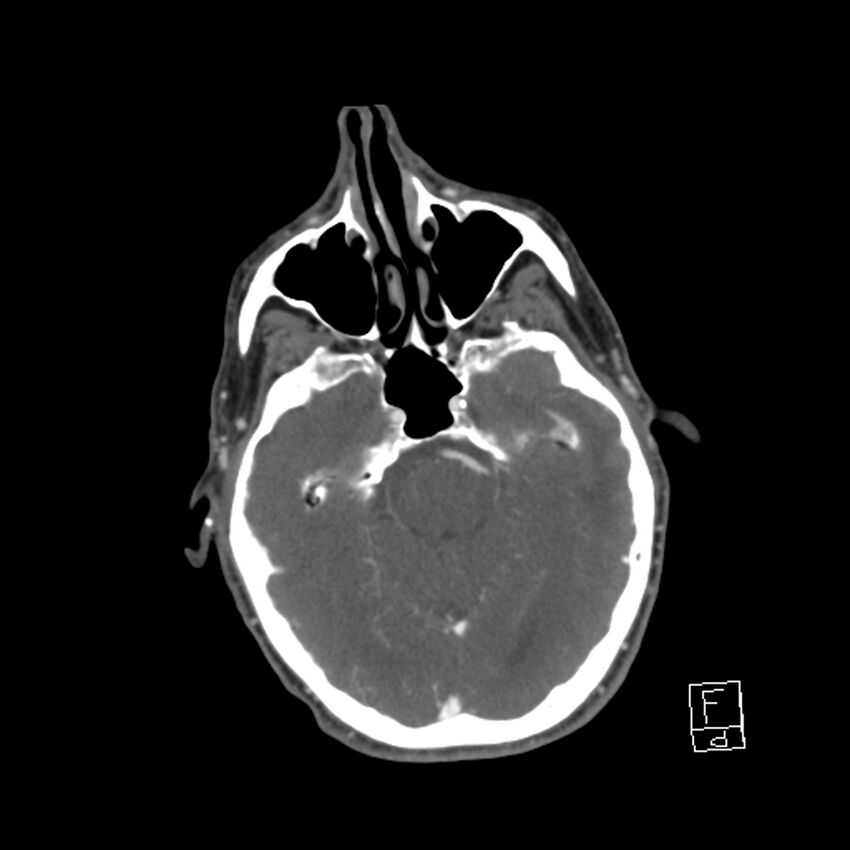 Acute ICA ischemic penumbra due to high-grade CCA stenosis (CT perfusion) (Radiopaedia 72038-82530 Axial C+ arterial phase 13).jpg