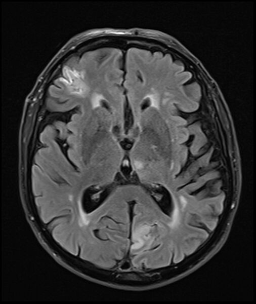 File:Acute P1 occlusion with PCA ischemia penumbra (CT perfusion) (Radiopaedia 72084-82590 Axial FLAIR 19).jpg